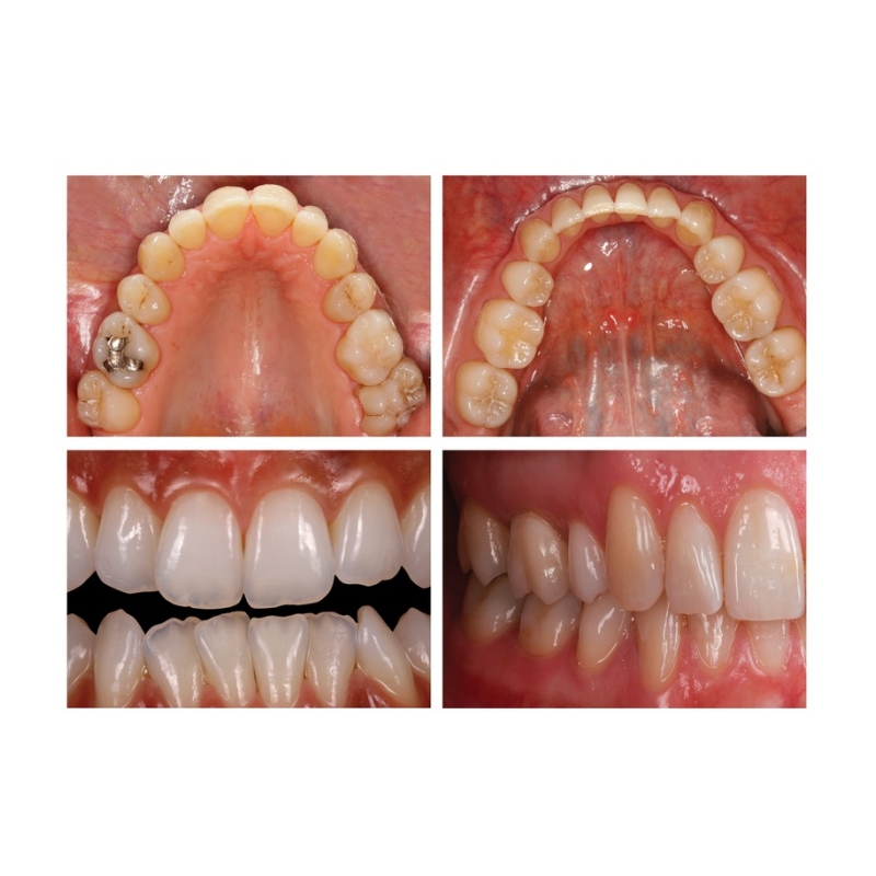 Intraoral Photo Mirror 06