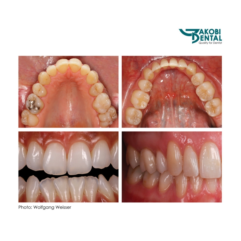 Intraoral Photo Mirror 01