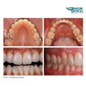 Intraoral Photo Mirror 01